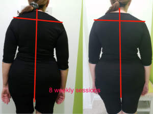 Jade, a Caloundra local, noticed a massive improvement in her scoliosis and back pain in 8 weekly sessions 1