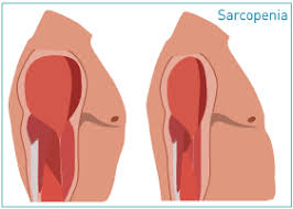 Elderly and sarcopenia (age related muscle loss)
